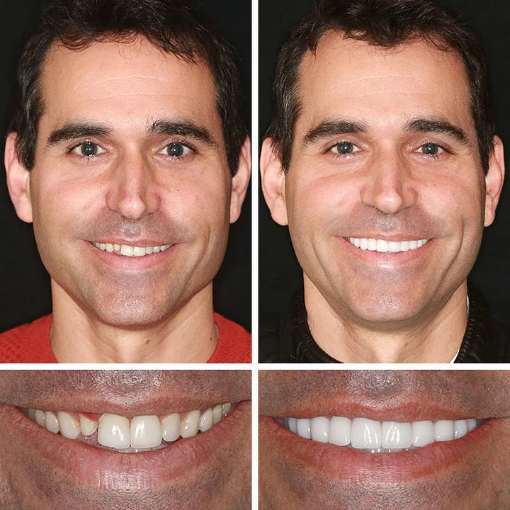 🦷 DarkFairy™ Medical Full Denture with Strong Suctiond Custom-Fit Full Functional Dentures