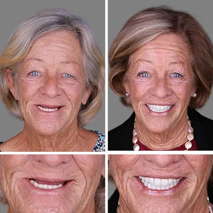 🦷 DarkFairy™ Medical Full Denture with Strong Suctiond Custom-Fit Full Functional Dentures