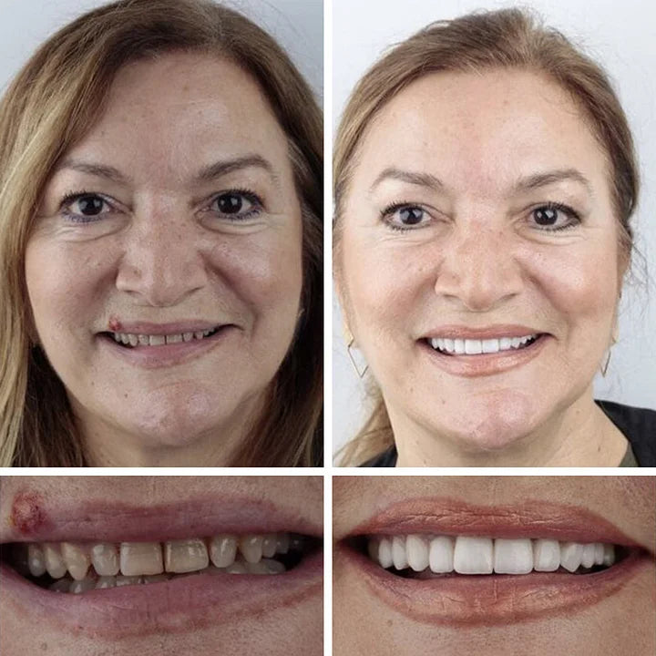 🦷 DarkFairy™ Medical Full Denture with Strong Suctiond Custom-Fit Full Functional Dentures