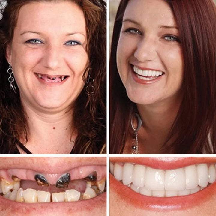 🦷 DarkFairy™ Medical Full Denture with Strong Suctiond Custom-Fit Full Functional Dentures