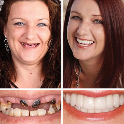 🦷 DarkFairy™ Medical Full Denture with Strong Suctiond Custom-Fit Full Functional Dentures